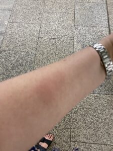 Yesterday at the AWS meetup, a 🐝 wasp stung me on the forearm. It’s been painful, swollen and itchy for the last 24 hours. However, today was a really excellent day at work. I had two really good things happen. I don’t know if it’s the universe saying Sorry, but I’ll take it! ❤️ https://t.co/y9jsJbv5qW